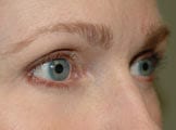 Blepharoplasty Eyelid Surgeon