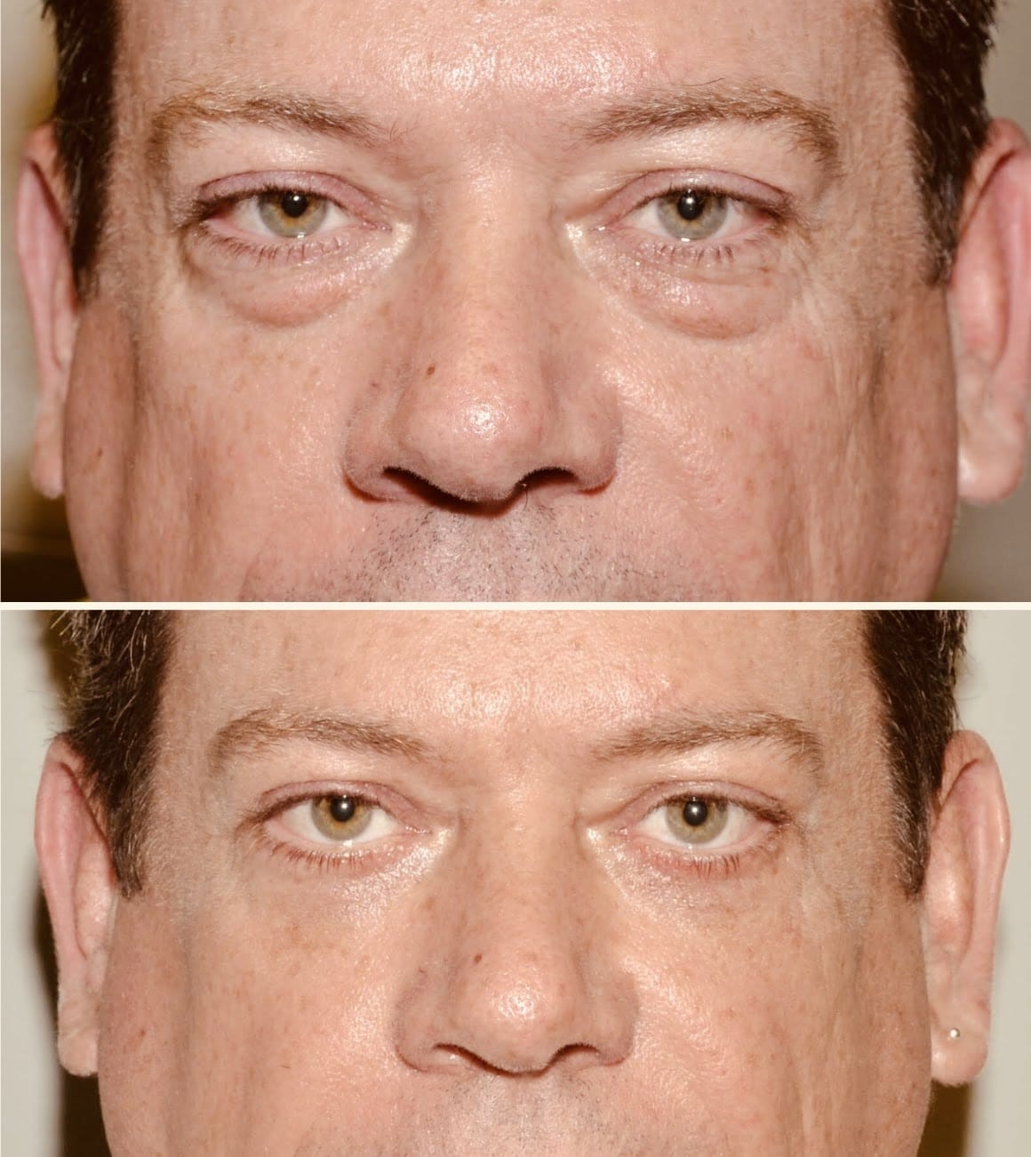 Eyelid Surgery Daytona Beach, FL Dr. Samson
