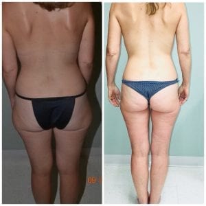 Liposuction Before and After Daytona Beach, Best Liposuction Surgeon Daytona Beach, Top Plastic Surgeon Daytona Beach, Port Orange Plastic Surgeon