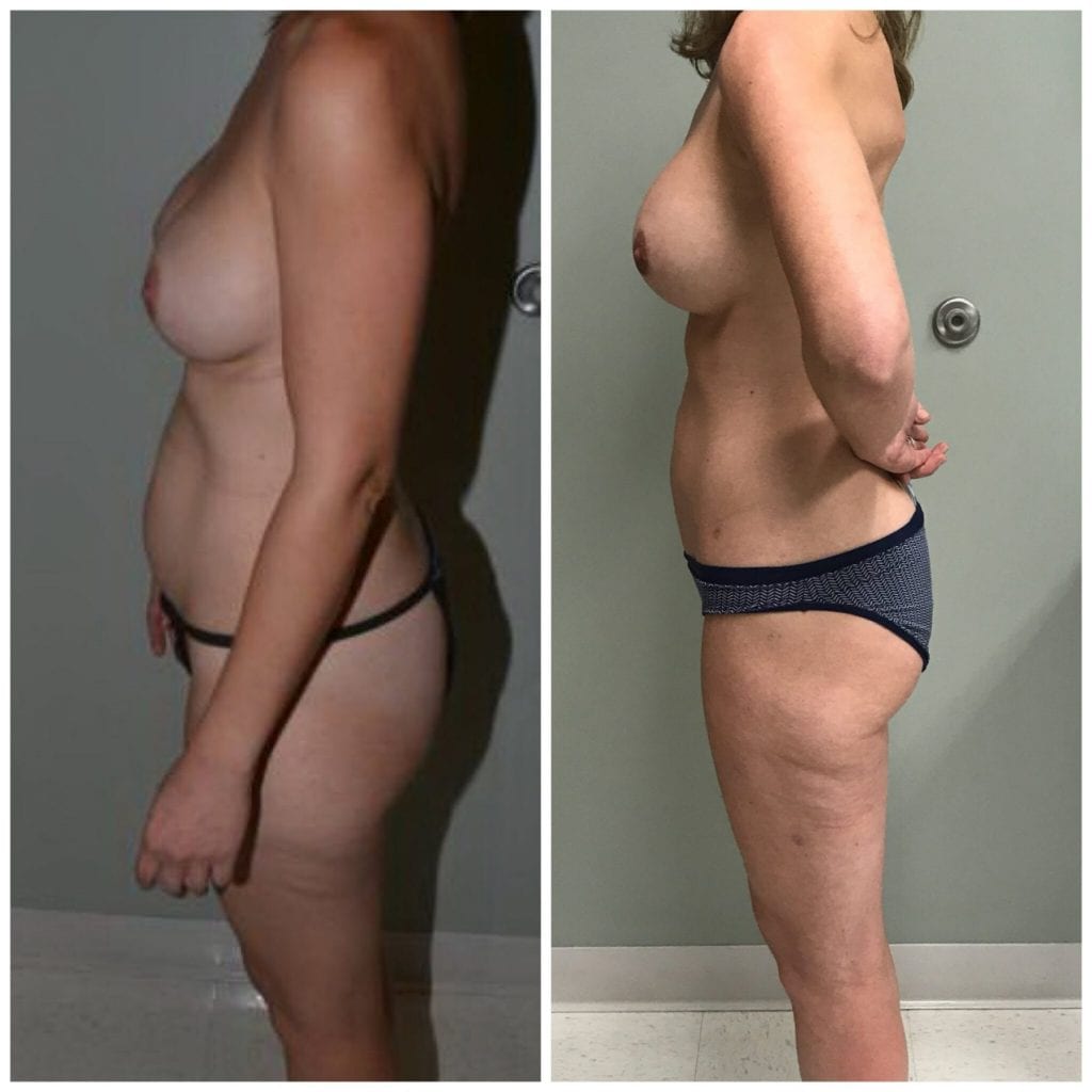 Lipo, Coolsculpting