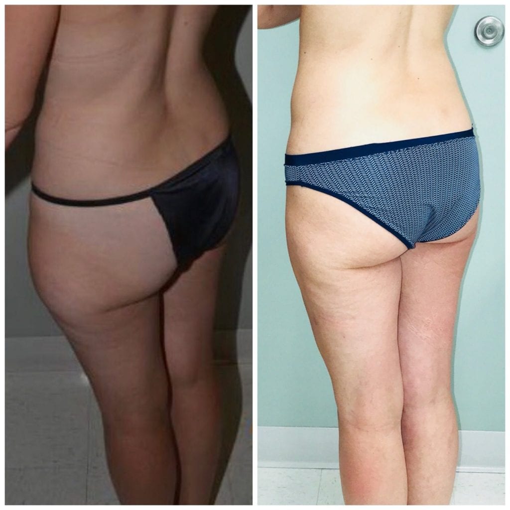 Liposuction Before and After Daytona Beach, Best Liposuction Surgeon Daytona Beach, Top Plastic Surgeon Daytona Beach, Port Orange Plastic Surgeon, Mommy Makeover Daytona Beach. Breast Augmentation Daytona Beach, Best Breast Augmentation Surgeon Daytona Beach, Affordable Breast Augmentation Daytona Beach