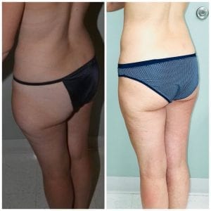 Liposuction Before and After Daytona Beach, Best Liposuction Surgeon Daytona Beach, Top Plastic Surgeon Daytona Beach, Port Orange Plastic Surgeon, Mommy Makeover Daytona Beach. Breast Augmentation Daytona Beach, Best Breast Augmentation Surgeon Daytona Beach, Affordable Breast Augmentation Daytona Beach