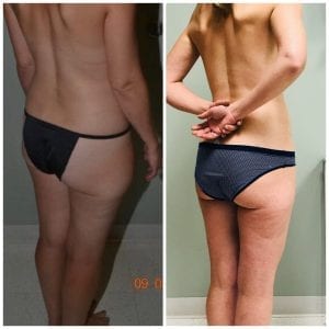 Liposuction Before and After Daytona Beach, Best Liposuction Surgeon Daytona Beach, Top Plastic Surgeon Daytona Beach, Port Orange Plastic Surgeon, Mommy Makeover Daytona Beach. Breast Augmentation Daytona Beach, Best Breast Augmentation Surgeon Daytona Beach, Affordable Breast Augmentation Daytona Beach