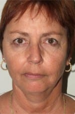 Facelift Daytona Beach, Eyelid Surgery Daytona Beach, Plastic Surgeon Daytona Beach Eyelift, Bleph Surgery Port Orange, Blepharoplasty Surgeon Daytona Beach, Eyelid Lift, Facelift Daytona Beach, Ormond Beach Eyelift and Facelift, Board Certified Plastic Surgeon Daytona Beach, Dr. Samson Facelift Reviews