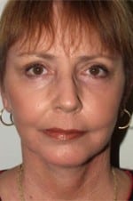 Cost of Facelift