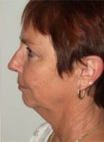 Facelift Daytona Beach, Eyelid Surgery Daytona Beach, Plastic Surgeon Daytona Beach Eyelift, Bleph Surgery Port Orange, Blepharoplasty Surgeon Daytona Beach, Eyelid Lift, Facelift Daytona Beach, Ormond Beach Eyelift and Facelift, Board Certified Plastic Surgeon Daytona Beach, Dr. Samson Facelift Reviews