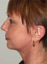 Facelift Daytona Beach, Eyelid Surgery Daytona Beach, Plastic Surgeon Daytona Beach Eyelift, Bleph Surgery Port Orange, Blepharoplasty Surgeon Daytona Beach, Eyelid Lift, Facelift Daytona Beach, Ormond Beach Eyelift and Facelift, Board Certified Plastic Surgeon Daytona Beach, Dr. Samson Facelift Reviews