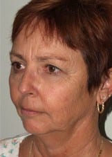 Facelift Daytona Beach, Eyelid Surgery Daytona Beach, Plastic Surgeon Daytona Beach Eyelift, Bleph Surgery Port Orange, Blepharoplasty Surgeon Daytona Beach, Eyelid Lift, Facelift Daytona Beach, Ormond Beach Eyelift and Facelift, Board Certified Plastic Surgeon Daytona Beach, Dr. Samson Facelift Reviews