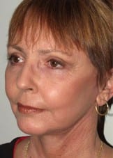 Facelift Daytona Beach, Eyelid Surgery Daytona Beach, Plastic Surgeon Daytona Beach Eyelift, Bleph Surgery Port Orange, Blepharoplasty Surgeon Daytona Beach, Eyelid Lift, Facelift Daytona Beach, Ormond Beach Eyelift and Facelift, Board Certified Plastic Surgeon Daytona Beach, Dr. Samson Facelift Reviews