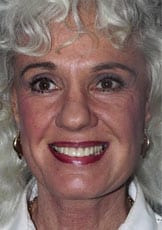 Facelift Daytona Beach, Eyelid Surgery Daytona Beach, Plastic Surgeon Daytona Beach Eyelift, Bleph Surgery Port Orange, Blepharoplasty Surgeon Daytona Beach, Eyelid Lift, Facelift Daytona Beach, Ormond Beach Eyelift and Facelift, Board Certified Plastic Surgeon Daytona Beach, Dr. Samson Facelift Reviews