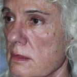 Facelift Daytona Beach, Eyelid Surgery Daytona Beach, Plastic Surgeon Daytona Beach Eyelift, Bleph Surgery Port Orange, Blepharoplasty Surgeon Daytona Beach, Eyelid Lift, Facelift Daytona Beach, Ormond Beach Eyelift and Facelift, Board Certified Plastic Surgeon Daytona Beach, Dr. Samson Facelift Reviews