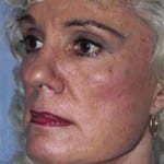 Facelift Daytona Beach, Eyelid Surgery Daytona Beach, Plastic Surgeon Daytona Beach Eyelift, Bleph Surgery Port Orange, Blepharoplasty Surgeon Daytona Beach, Eyelid Lift, Facelift Daytona Beach, Ormond Beach Eyelift and Facelift, Board Certified Plastic Surgeon Daytona Beach, Dr. Samson Facelift Reviews