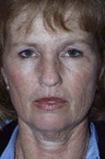 Facelift Daytona Beach, Eyelid Surgery Daytona Beach, Plastic Surgeon Daytona Beach Eyelift, Bleph Surgery Port Orange, Blepharoplasty Surgeon Daytona Beach, Eyelid Lift, Facelift Daytona Beach, Ormond Beach Eyelift and Facelift, Board Certified Plastic Surgeon Daytona Beach, Dr. Samson Facelift Reviews