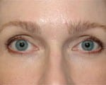 Facelift Daytona Beach, Eyelid Surgery Daytona Beach, Plastic Surgeon Daytona Beach Eyelift, Bleph Surgery Port Orange, Blepharoplasty Surgeon Daytona Beach, Eyelid Lift, Facelift Daytona Beach, Ormond Beach Eyelift and Facelift, Board Certified Plastic Surgeon Daytona Beach, Dr. Samson Facelift Reviews
