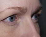 Facelift Daytona Beach, Eyelid Surgery Daytona Beach, Plastic Surgeon Daytona Beach Eyelift, Bleph Surgery Port Orange, Blepharoplasty Surgeon Daytona Beach, Eyelid Lift, Facelift Daytona Beach, Ormond Beach Eyelift and Facelift, Board Certified Plastic Surgeon Daytona Beach, Dr. Samson Facelift Reviews