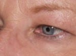 Facelift Daytona Beach, Eyelid Surgery Daytona Beach, Plastic Surgeon Daytona Beach Eyelift, Bleph Surgery Port Orange, Blepharoplasty Surgeon Daytona Beach, Eyelid Lift, Facelift Daytona Beach, Ormond Beach Eyelift and Facelift, Board Certified Plastic Surgeon Daytona Beach, Dr. Samson Facelift Reviews