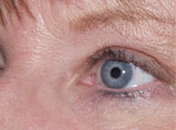 Facelift Daytona Beach, Eyelid Surgery Daytona Beach, Plastic Surgeon Daytona Beach Eyelift, Bleph Surgery Port Orange, Blepharoplasty Surgeon Daytona Beach, Eyelid Lift, Facelift Daytona Beach, Ormond Beach Eyelift and Facelift, Board Certified Plastic Surgeon Daytona Beach, Dr. Samson Facelift Reviews