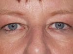 Facelift Daytona Beach, Eyelid Surgery Daytona Beach, Plastic Surgeon Daytona Beach Eyelift, Bleph Surgery Port Orange, Blepharoplasty Surgeon Daytona Beach, Eyelid Lift, Facelift Daytona Beach, Ormond Beach Eyelift and Facelift, Board Certified Plastic Surgeon Daytona Beach, Dr. Samson Facelift Reviews