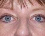 Blepharoplasty surgeon