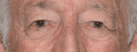 Facelift Daytona Beach, Eyelid Surgery Daytona Beach, Plastic Surgeon Daytona Beach Eyelift, Bleph Surgery Port Orange, Blepharoplasty Surgeon Daytona Beach, Eyelid Lift, Facelift Daytona Beach, Ormond Beach Eyelift and Facelift, Board Certified Plastic Surgeon Daytona Beach, Dr. Samson Facelift Reviews