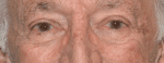 Facelift Daytona Beach, Eyelid Surgery Daytona Beach, Plastic Surgeon Daytona Beach Eyelift, Bleph Surgery Port Orange, Blepharoplasty Surgeon Daytona Beach, Eyelid Lift, Facelift Daytona Beach, Ormond Beach Eyelift and Facelift, Board Certified Plastic Surgeon Daytona Beach, Dr. Samson Facelift Reviews