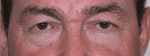 Facelift Daytona Beach, Eyelid Surgery Daytona Beach, Plastic Surgeon Daytona Beach Eyelift, Bleph Surgery Port Orange, Blepharoplasty Surgeon Daytona Beach, Eyelid Lift, Facelift Daytona Beach, Ormond Beach Eyelift and Facelift, Board Certified Plastic Surgeon Daytona Beach, Dr. Samson Facelift Reviews