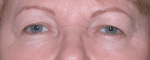 Facelift Daytona Beach, Eyelid Surgery Daytona Beach, Plastic Surgeon Daytona Beach Eyelift, Bleph Surgery Port Orange, Blepharoplasty Surgeon Daytona Beach, Eyelid Lift, Facelift Daytona Beach, Ormond Beach Eyelift and Facelift, Board Certified Plastic Surgeon Daytona Beach, Dr. Samson Facelift Reviews