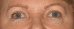 Facelift Daytona Beach, Eyelid Surgery Daytona Beach, Plastic Surgeon Daytona Beach Eyelift, Bleph Surgery Port Orange, Blepharoplasty Surgeon Daytona Beach, Eyelid Lift, Facelift Daytona Beach, Ormond Beach Eyelift and Facelift, Board Certified Plastic Surgeon Daytona Beach, Dr. Samson Facelift Reviews, Board Certified Plastic Surgeon Facelift Eyelift Daytona Beach