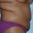 Tummy Tuck Daytona Beach, Best Plastic Surgeon Daytona Beach, Dr. Samson Tummy Tuck, Board Certified Plastic Surgeon Daytona Beach, Mommy Makeover Daytona Beach, Port Orange Mommy Makeover, Abdominoplasty Daytona Beach