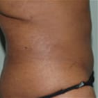 Tummy Tuck Daytona Beach, Best Plastic Surgeon Daytona Beach, Dr. Samson Tummy Tuck, Board Certified Plastic Surgeon Daytona Beach