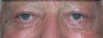 Facelift Daytona Beach, Eyelid Surgery Daytona Beach, Plastic Surgeon Daytona Beach Eyelift, Bleph Surgery Port Orange, Blepharoplasty Surgeon Daytona Beach, Eyelid Lift, Facelift Daytona Beach, Ormond Beach Eyelift and Facelift, Board Certified Plastic Surgeon Daytona Beach, Dr. Samson Facelift Reviews, Board Certified Plastic Surgeon Facelift Eyelift Daytona Beach