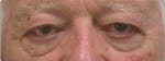 Facelift Daytona Beach, Eyelid Surgery Daytona Beach, Plastic Surgeon Daytona Beach Eyelift, Bleph Surgery Port Orange, Blepharoplasty Surgeon Daytona Beach, Eyelid Lift, Facelift Daytona Beach, Ormond Beach Eyelift and Facelift, Board Certified Plastic Surgeon Daytona Beach, Dr. Samson Facelift Reviews, Board Certified Plastic Surgeon Facelift Eyelift Daytona Beach