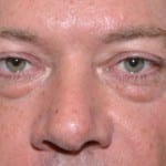 Facelift Daytona Beach, Eyelid Surgery Daytona Beach, Plastic Surgeon Daytona Beach Eyelift, Bleph Surgery Port Orange, Blepharoplasty Surgeon Daytona Beach, Eyelid Lift, Facelift Daytona Beach, Ormond Beach Eyelift and Facelift, Board Certified Plastic Surgeon Daytona Beach, Dr. Samson Facelift Reviews, Board Certified Plastic Surgeon Facelift Eyelift Daytona Beach
