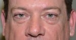 Facelift Daytona Beach, Eyelid Surgery Daytona Beach, Plastic Surgeon Daytona Beach Eyelift, Bleph Surgery Port Orange, Blepharoplasty Surgeon Daytona Beach, Eyelid Lift, Facelift Daytona Beach, Ormond Beach Eyelift and Facelift, Board Certified Plastic Surgeon Daytona Beach, Dr. Samson Facelift Reviews, Board Certified Plastic Surgeon Facelift Eyelift Daytona Beach