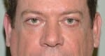 Facelift Daytona Beach, Eyelid Surgery Daytona Beach, Plastic Surgeon Daytona Beach Eyelift, Bleph Surgery Port Orange, Blepharoplasty Surgeon Daytona Beach, Eyelid Lift, Facelift Daytona Beach, Ormond Beach Eyelift and Facelift, Board Certified Plastic Surgeon Daytona Beach, Dr. Samson Facelift Reviews, Board Certified Plastic Surgeon Facelift Eyelift Daytona Beach