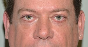 Facelift Daytona Beach, Eyelid Surgery Daytona Beach, Plastic Surgeon Daytona Beach Eyelift, Bleph Surgery Port Orange, Blepharoplasty Surgeon Daytona Beach, Eyelid Lift, Facelift Daytona Beach, Ormond Beach Eyelift and Facelift, Board Certified Plastic Surgeon Daytona Beach, Dr. Samson Facelift Reviews, Board Certified Plastic Surgeon Facelift Eyelift Daytona Beach
