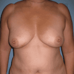 Daytona Beach Reconstruction Surgeon, Best Daytona Beach Reconstruction Surgeon, Top Rated Reconstruction Surgeon Daytona Beach