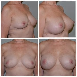 Breast Augmentation Daytona Beach Breast Augmentation Breast Augmentation Port Orange Ormond Beach Breast Augmentation Before and After Breast Augmentation Daytona Beach Before and After Breast Augmentation Port Orange Before and After Breast Augmentation Ormond Beach Best Breast Augmentation Plastic Surgeon Volusia County Dr. Samson Breast Augmentation Before and After Breast Aug Plastic Surgeon Near Me