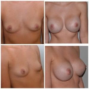 Best Breast Augmentation Surgeon