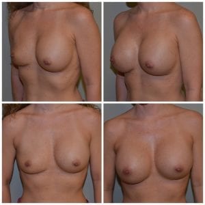 Breast Augmentation Daytona Beach Breast Augmentation Breast Augmentation Port Orange Ormond Beach Breast Augmentation Before and After Breast Augmentation Daytona Beach Before and After Breast Augmentation Port Orange Before and After Breast Augmentation Ormond Beach Best Breast Augmentation Plastic Surgeon Volusia County Dr. Samson Breast Augmentation Before and After Breast Aug Plastic Surgeon Near Me Breast Augmentation Surgery Cost Breast Augmentation Recovery Breast Augmentation Florida
