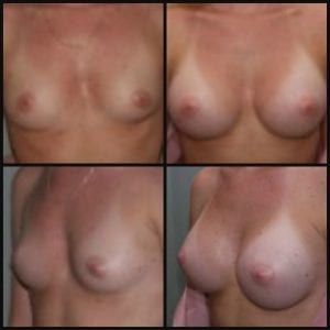 Breast Augmentation Ormond Beach