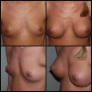 Breast Augmentation Daytona Beach Breast Augmentation Breast Augmentation Port Orange Ormond Beach Breast Augmentation Before and After Breast Augmentation Daytona Beach Before and After Breast Augmentation Port Orange Before and After Breast Augmentation Ormond Beach Best Breast Augmentation Plastic Surgeon Volusia County Dr. Samson Breast Augmentation Before and After Breast Aug Plastic Surgeon Near Me Breast Augmentation Surgery Cost Breast Augmentation Recovery Breast Augmentation Florida