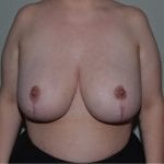 Breast Reduction Daytona Beach, Port Orange Breast Reduction