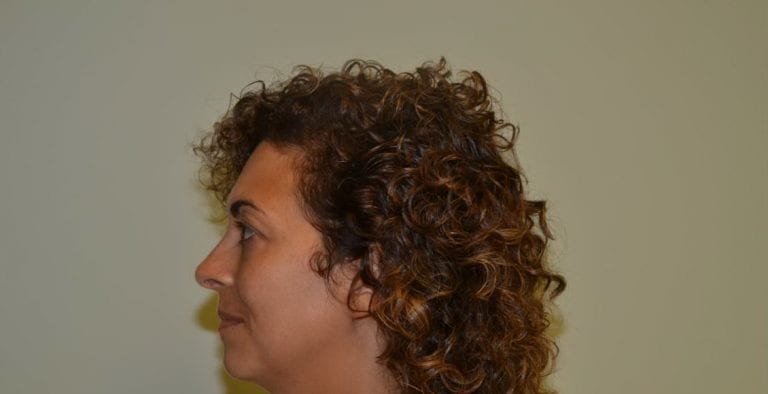 Rhinoplasty Daytona Beach, Daytona Beach Rhinoplasty Doctor, Rhinoplasty Port Orange, Best Rhinoplasty Dr Daytona Beach. Facelift Daytona Beach, Eyelid Surgery Daytona Beach, Plastic Surgeon Daytona Beach Eyelift, Bleph Surgery Port Orange, Blepharoplasty Surgeon Daytona Beach, Eyelid Lift, Facelift Daytona Beach, Ormond Beach Eyelift and Facelift, Board Certified Plastic Surgeon Daytona Beach, Dr. Samson Facelift Reviews, Board Certified Plastic Surgeon Facelift Eyelift Daytona Beach, Botox Daytona Beach, Lip Filler Daytona Beach, Best Botox Daytona Beach, Best Lip Filler Daytona Beach, Botox Port Orange, Lip Filler Port Orange, Juvederm Daytona Beach, Top Injector Daytona Beach