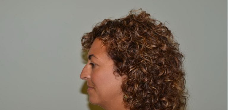 Rhinoplasty Daytona Beach, Daytona Beach Rhinoplasty Doctor, Rhinoplasty Port Orange, Best Rhinoplasty Dr Daytona Beach. Facelift Daytona Beach, Eyelid Surgery Daytona Beach, Plastic Surgeon Daytona Beach Eyelift, Bleph Surgery Port Orange, Blepharoplasty Surgeon Daytona Beach, Eyelid Lift, Facelift Daytona Beach, Ormond Beach Eyelift and Facelift, Board Certified Plastic Surgeon Daytona Beach, Dr. Samson Facelift Reviews, Board Certified Plastic Surgeon Facelift Eyelift Daytona Beach, Botox Daytona Beach, Lip Filler Daytona Beach, Best Botox Daytona Beach, Best Lip Filler Daytona Beach, Botox Port Orange, Lip Filler Port Orange, Juvederm Daytona Beach, Top Injector Daytona Beach