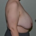 Breast Reduction Daytona Beach, Port Orange Breast Reduction