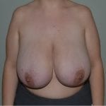 Breast Reduction Daytona Beach, Port Orange Breast Reduction
