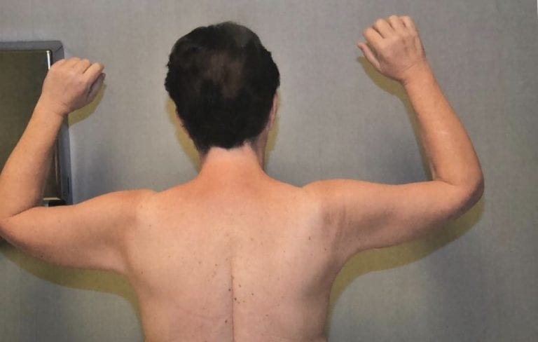 Brachioplasty/Arm Lift