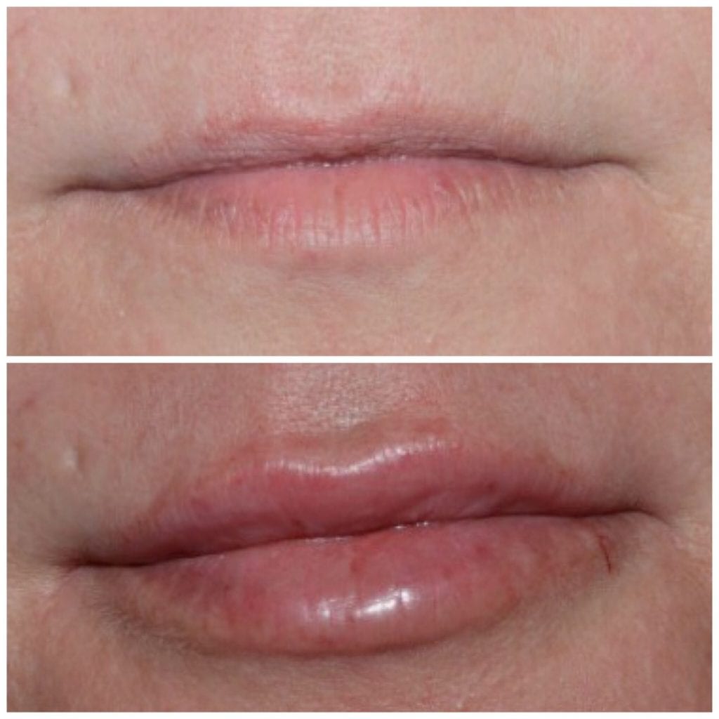 Lip Injections/Lip Filler/Juvederm Daytona Beach Lip Filler Injections Juvederm Lip Filler Injections Juvederm Port Orange Ormond Beach Lip Filler Injections Before and After Lip Filler Daytona Beach Before and After Lip Injections Port Orange Before and After Lip Filler Injections Ormond Beach Best Lip Filler Plastic Surgeon Volusia County Dr. Samson Lip Fillers Before and After Lip Fillers Plastic Surgeon Near Me Botox Bar Juvederm Injections Daytona Beach