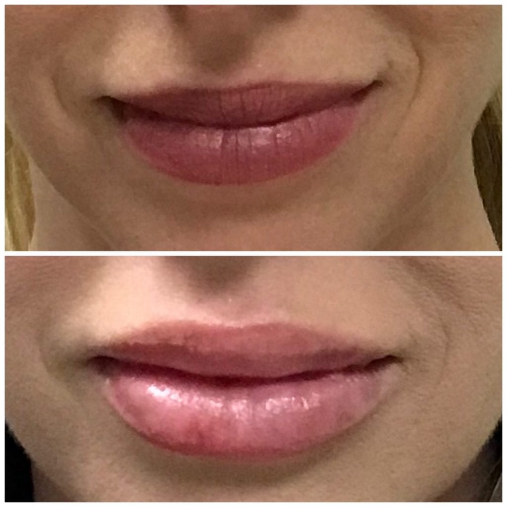 Lip Injections/Lip Filler/Juvederm Daytona Beach Lip Filler Injections Juvederm Lip Filler Injections Juvederm Port Orange Ormond Beach Lip Filler Injections Before and After Lip Filler Daytona Beach Before and After Lip Injections Port Orange Before and After Lip Filler Injections Ormond Beach Best Lip Filler Plastic Surgeon Volusia County Dr. Samson Lip Fillers Before and After Lip Fillers Plastic Surgeon Near Me Botox Bar Juvederm Injections Daytona Beach